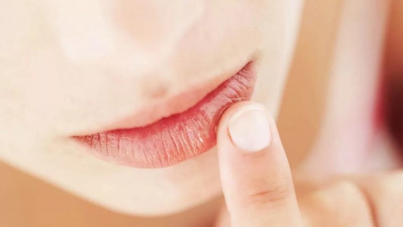 Трещины в уголках губ: причины, лечение 