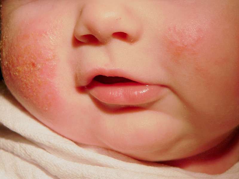 Атопический дерматит у детей: лечение