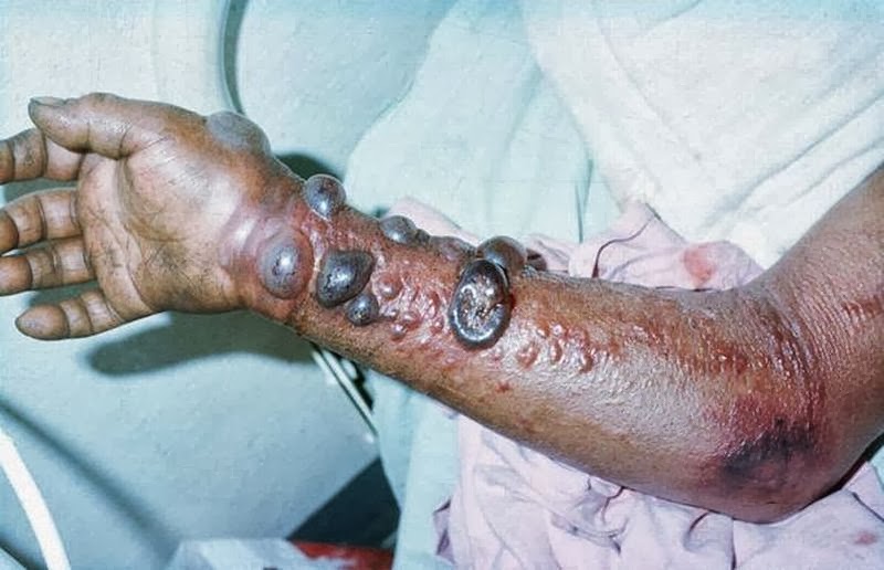 фото больны лихорадка эбола