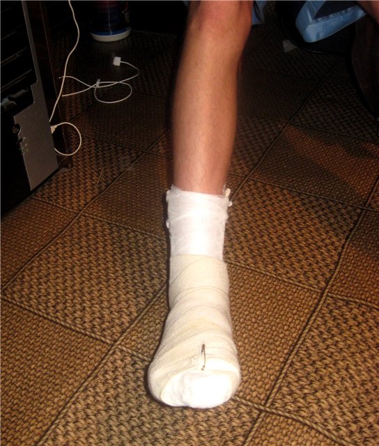 Фото Сломанной Ноги В Гипсе Девушки
