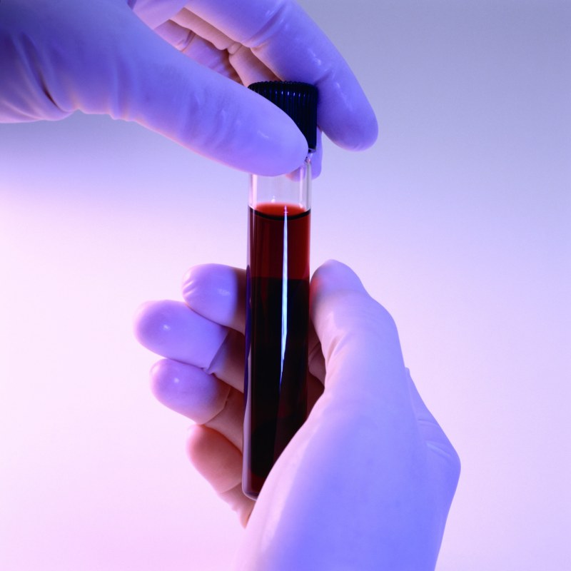 Как повысить соэ в анализе крови thumbnail