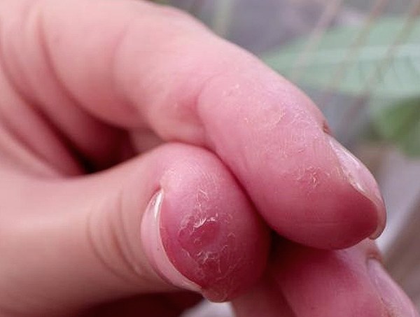 У ребенка шелушится кожа на пальцах рук и стоп