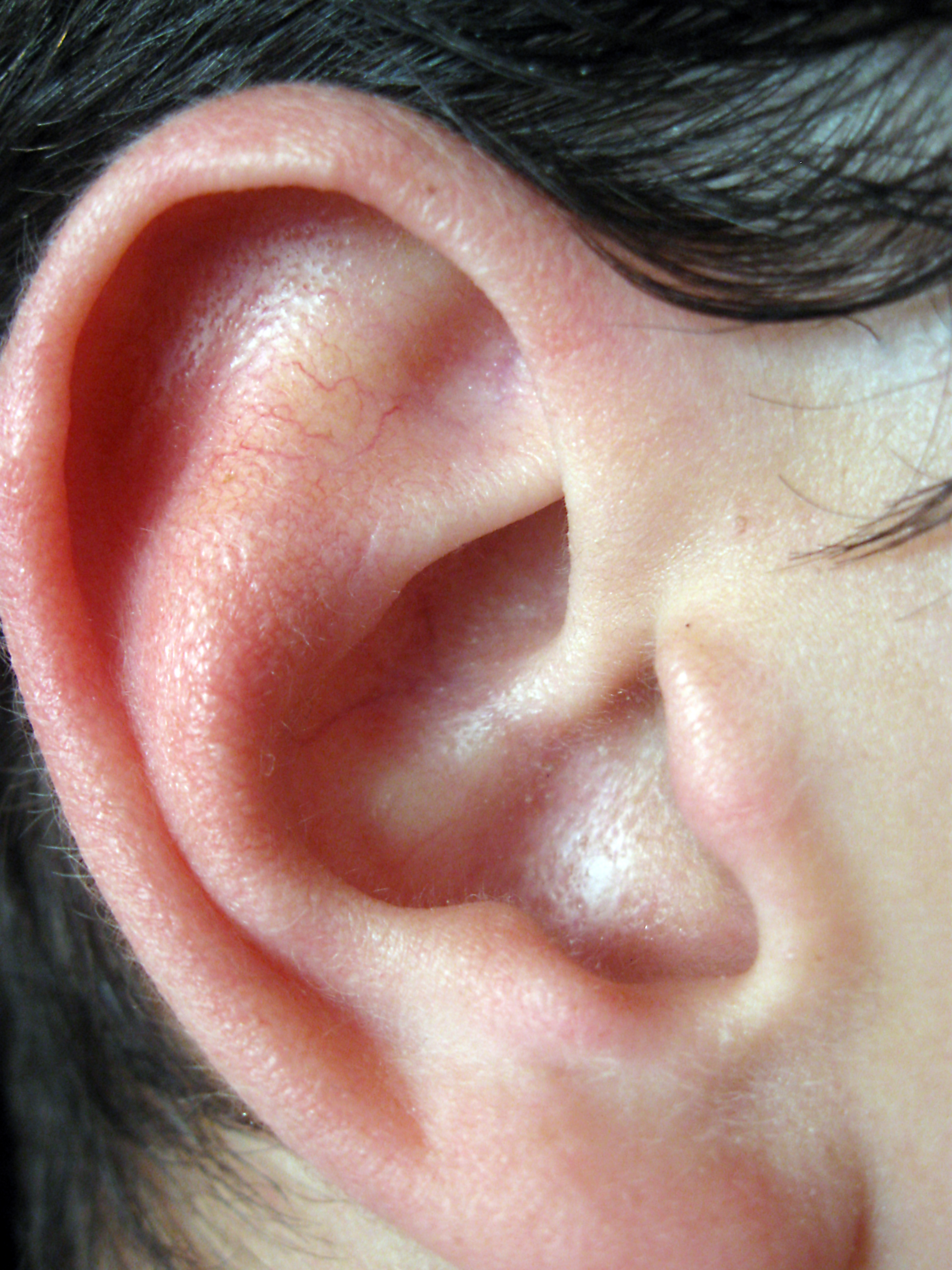 Показать картинку уха. Отопластика (1 ушная раковина).