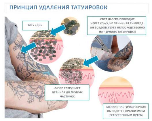 Принцип удаления татуировок