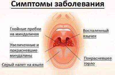 Стафилококк во рту лечение 25