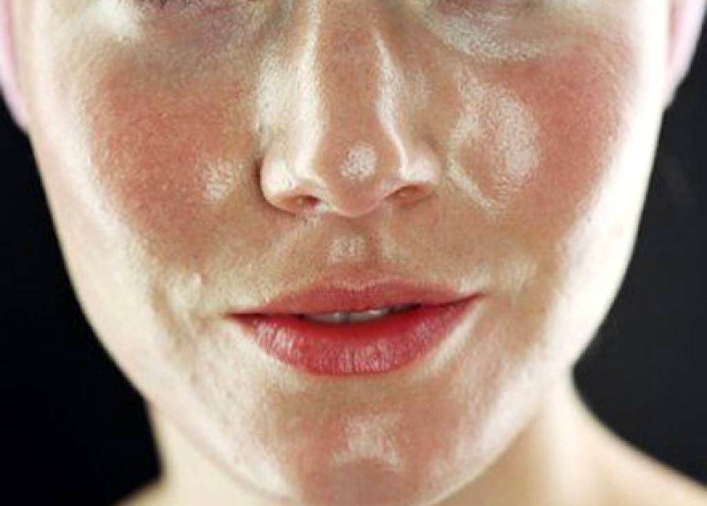 Очищение жирной кожи лица