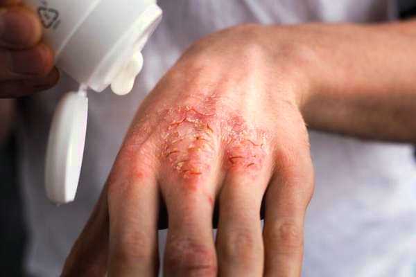 Чим небезпечний антисептик після миття рук з милом