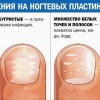 Диагностика организма через ногти