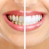 Что такое зубной налет и чем он опасен