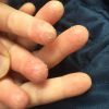 Почему трескается кожа на пальцах рук