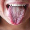 Почему появляется белый налет на языке у взрослых
