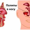 Полипы в носу: что это такое, симптомы, лечение, причины возникновения