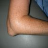 Бурсит локтевого сустава: симптомы и лечение