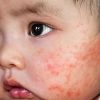 Как избавиться от атопического дерматита у ребенка