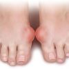 лечение бурсита большого пальца ноги