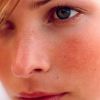 Розацеа на лице: причины, симптомы, диета и лечение