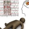 Абсансная эпилепсия: симптомы и лечение