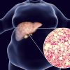 Ожирение печени: как не допустить развития цирроза 