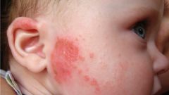 How to treat heat rash in infants
