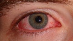 How to get rid of red blood vessels in the eyes