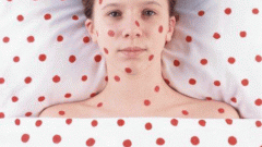 How to protect yourself from chicken pox