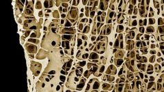 How to recover bone tissue