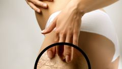 How to get rid of stretch marks on buttocks