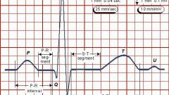 How to read an EKG
