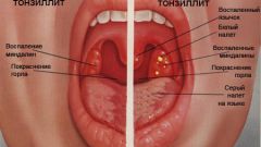 Как лечить першение в горле