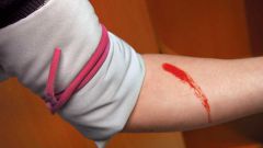 How to stop arterial bleeding