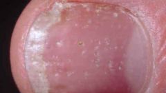 How to treat nail psoriasis