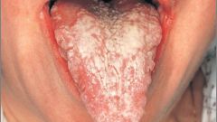 Как лечить кандидоз рта