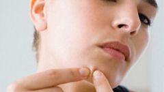 Угревая сыпь: как убрать ее с лица