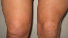 How to remove fluid in the knee