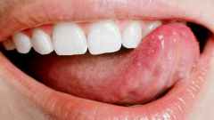 How to get rid of pimple on tongue