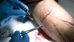 Как обработать резаную рану
