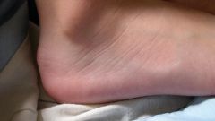 How to get rid of warts on the heel