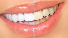 Что делать, чтобы зубы оставались белыми
