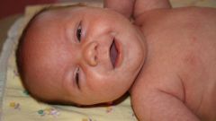 How to treat white patches on the tongue in infants