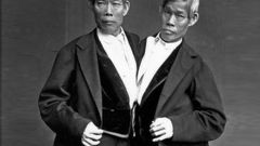 The most famous conjoined twins