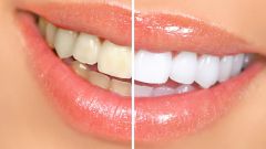 Что такое дисколорит зубов