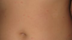 Itchy abdomen - what to do? Why the stomach small rash