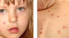 That allowed a child with chickenpox
