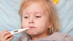 How contagious chicken pox
