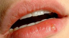 How to treat ulcer on the lip