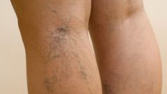 How to remove bulging veins in the legs