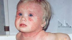 Как выглядит дерматит у ребенка
