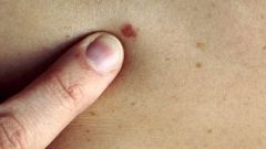 How to check a mole on Oncology