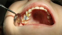 Как выглядит зуб без нерва