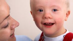 Причины рождения детей с синдромом Дауна 